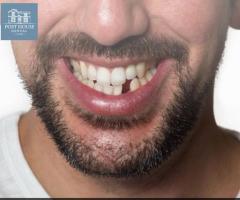 Lost a Tooth? Here's What You Need to Know!
