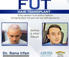 Best Fut Hair Transplant in Islamabad