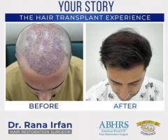 The Best Hair Transplant in Islamabad