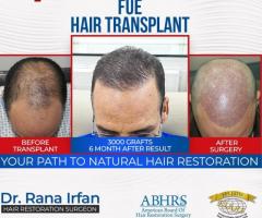 Best Fue Hair Transplant in Islamabad