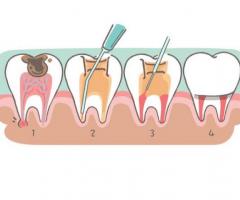Are you in search of a RCT Treatment and Best Dentist Clinic  to enhance your Smile?