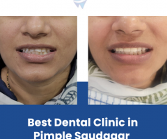 Best Dental Clinic in Pimple Saudagar | Contact Us @8055889900 - 1