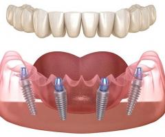 Transform Your Smilе with All-on-4 Dеntal Implants - Affordablе Solution!