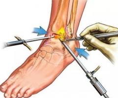 Arthroscopic Knee Surgery