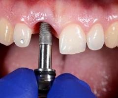 Premium Dental Implant Services Now at Deniliquin - 1