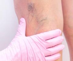 Sclerotherapy Treatment For Varicose And Spider veins In Union City | Advanced Medical Group
