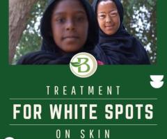 Understanding Vitiligo and Exploring Homeopathic Treatments for Vitiligo