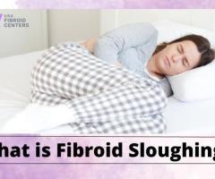 Fibroid Necrosis: Understanding Symptoms, Causes, and Treatment