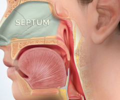 Find Effective Septal Perforation Repair with Septal Perforation - Your Trusted Solution