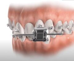 Braces Treatment Murrieta | Pesh Orthodontics