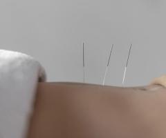 Get relief from muscle spasms with dry needling physio