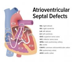 Atrioventricular Canal Defect Causes, Symptoms, Treatment