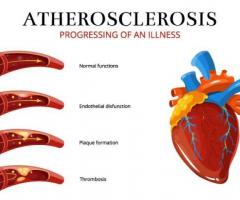 Atherosclerosis Causes, Symptoms, Treatment in India | Medanata