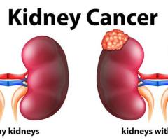 Kidney Cancer Treatments in Bangalore | Worldofurology