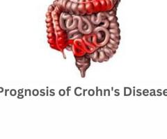 Managing the Prognosis of Crohn's Disease