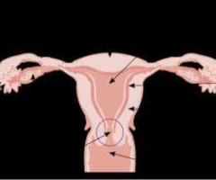 A Non-Surgical Solution for Large UFE Fibroids