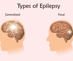 Epilepsy: Causes, Symptoms, Diagnosis and Treatment - 1