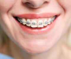 Get Braces in Singapore – Cost-Effective Solutions for All Ages