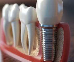 Dental Implants Singapore for Missing Teeth and Tooth Replacement