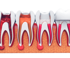 Gupta Dental Care Center - Root Canal Treatment in Dwarka