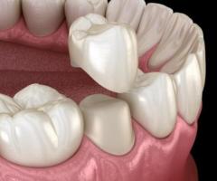 Pleasant Dental: Transformative Full Mouth Reconstruction Services