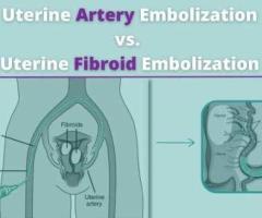 Uterine Artery Embolization: What You Need to Know