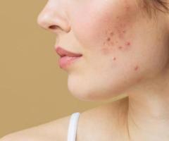 How To Prepare Your Skin Before Acne Scar Treatment?
