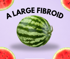 Treat Large UFE Fibroids Without Surgery