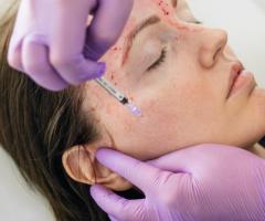 Rejuvenate Your Skin with a Vampire Facial at Lifestyle's MedSpa in Warrenton