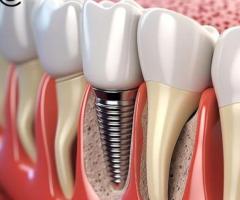 Dental Fees - Andover, Whitchurch, Hampshire, Sandbanks & Southampton - 1