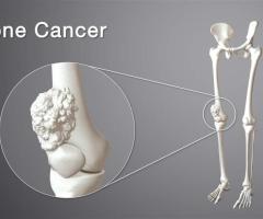 How Does Bone Cancer Develop?