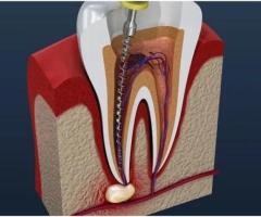 ROOT CANAL TREATMENT in Goria