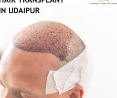 Hair Fall  Treatment in udaipur