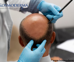 Growth Factor Treatment in Delhi | Advanced Alopecia Treatment at Kosmoderma