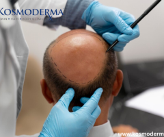 Kosmoderma: Effective Growth Factor and Alopecia Treatment in Bangalore