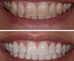 Laser teeth whitening | Dental Concepts - 1