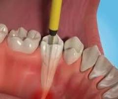 Root Canal Treatment in Mumbai, India - Dental concepts