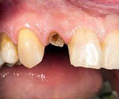 Broken Teeth Treatment by Experts