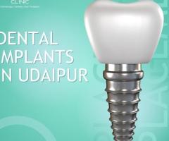 Best dental implants in udaipur