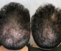 Scalp Treatment Warrenton VA | Healthy Hair Solutions at Lifestyle's MedSpa