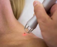 Revitalize Your Skin with Professional Mole and Skin Tag Removal