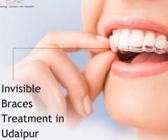 Invisible Braces Treatment  in Udaipur