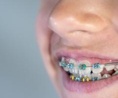 Straighten Your Teeth with Braces in Singapore – Treatment Plans for All Ages!