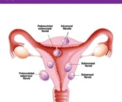 Intramural Leiomyoma of the Uterus: Understanding and Treating Intramural Fibroids