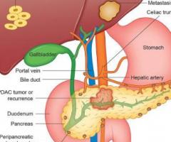 Carcinoma Pancreas Treatment, Symptoms, Causes & Diagnosis