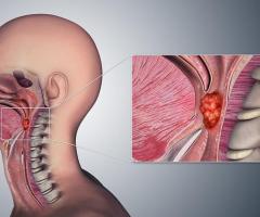 Laryngeal Cancer Causes, Symptoms, Treatment in India - 1