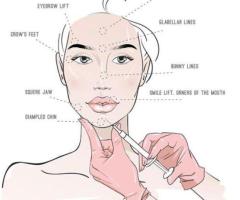 Best Dermal Fillers