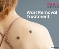 Advanced Warts Treatment at Anoos