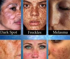 Facial spots disappear - Free Shipping