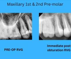 Root Canal Treatment | Dr. Inamdar's Dental Studio